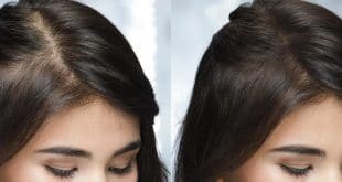 stempiatura femminile 310x165 - alopecia femminile